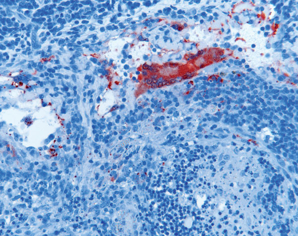 Lymphadenitis with syncytial cell formation in horse 2 experimentally infected with Hendra virus (HeV), Australia. Immunohistochemical staining of HeV N protein showing presence of antigen in red. Original magnification ×200.