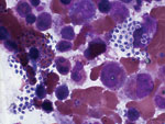 Thumbnail of Microsporidium species from bone marrow aspiration specimen (Wright stain) from a 43-year-old man, Thailand. The image shows focal aggregations of microsporidia-like microorganisms with a belt-like stripe (1.0–1.5 μm x 1.2-2.2 μm). Original magnification ×100.