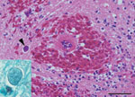 Thumbnail of Acute severe encephalomalacia in the caudal brainstem of a captive Yellow-spotted Bell Frog from Sydney, Australia. This lesion was characterized by hemorrhage, vascular necrosis, and parasites consistent with Myxozoa (arrowhead) (hematoxylin and eosin stain; scale bar = 50 μm). Staining for axons confirmed intraaxonal location of the myxozoan parasites (inset, Holmes silver nitrate with Loxul Fast Blue stain).