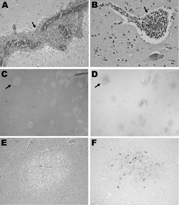 Histopathologic features for patient 12 in a study of children with eastern equine encephalitis (EEE), Massachusetts and New Hampshire, 1970–2010. The postmortem samples of central nervous system tissue were obtained 10 days after the onset of symptoms. A) Hematoxylin and eosin (H&amp;E)–stained section of temporal lobe, showing meningeal inflammation (arrow) (magnification ×200). B) H&amp;E-stained section of midbrain, showing perivascular inflammation (arrow) (magnification ×400). C–F) EEE vir