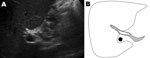 Thumbnail of A) Ultrasound of the liver of a patient with Fasciola hepatica infection, the Netherlands. B) Drawing of A; depicted are the liver (white), the common bile duct (gray), and the portal vein (black). A fluke (white), measuring 2.5–3 cm long, is identified in the common bile duct.