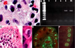 Thumbnail of Tissue specimens from a kidney transplant recipient with concurrent parasitic infections after traveling to the Dominican Republic. A) Tissue section stained with Gram chromotrope. Note the apical location of a cluster of Enterocytozoon bieneusi spores at arrow (original magnification ×1,000) and single spore at arrowhead.; B) Agarose gel showing PCR amplification of E. bieneusi 18S rDNA in the scraped section, as in panel A (M, 100-bp ladder; lane 1, DNA lysate diluted 1:5; lane 2,