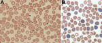 Thumbnail of A) Giemsa-stained thin blood smear for an 8-year-old boy from China showing erythrocytes with typical ring forms, paired pyriforms, and tetrads of a Babesia sp. (arrows). B) Giemsa-stained thin blood smear for a mouse with severely combined immunodeficiency, which had been injected with blood from the patient, showing Babesia sp.–infected erythrocytes (arrows). Original magnifications ×1,000.