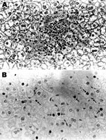 Thumbnail of Liver tissue from Chacma baboon 9732, South Africa, showing lobular hepatitis. Liver tissue was obtained at necropsy, fixed in formalin, embedded in paraffin, and sectioned. A) Hematoxylin and eosin staining, showing a focus of mild lobular hepatitis but no evidence of interface hepatitis or bridging necrosis. Portal tracts are normal. B) Immunoperoxidase staining with polyclonal antibody against hepatitis B core antigen. Core antigen was detected in the occasional hepatocyte nucleu