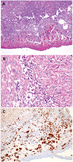 Thumbnail of Aortic valve from patient with Tropheryma whipplei endocarditis. A) Hematoxylin–eosin–saffron stain (original magnification ×100). B) Foamy macrophages containing characteristic inclusion bodies (periodic acid–Schiff stain; original magnification ×200). C) Immunostaining of T. whipplei with polyclonal rabbit antibody against T. whipplei and Mayer’s hemalum counterstain (original magnification ×100). No destruction of this valve is visible.