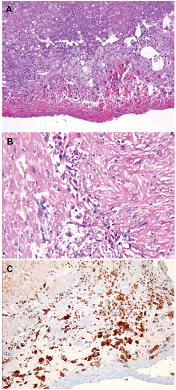 Aortic valve from patient with Tropheryma whipplei endocarditis. A) Hematoxylin–eosin–saffron stain (original magnification ×100). B) Foamy macrophages containing characteristic inclusion bodies (periodic acid–Schiff stain; original magnification ×200). C) Immunostaining of T. whipplei with polyclonal rabbit antibody against T. whipplei and Mayer’s hemalum counterstain (original magnification ×100). No destruction of this valve is visible.