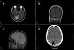 Thumbnail of Magnetic resonance (MR) and computed tomographic images of the brain of a 51-year-old woman infected with Taenia crassiceps tapeworm larvae, Germany. A) Transverse view, T1-weighted MR image. The 30 × 30 mm parasitic lesion with perifocal edema is located in the right hemisphere of the cerebellum and caused ataxia, headache, and nausea. The fourth ventricle is compressed. B) Coronal view, T2-weighted MR image. The cyst-like appearance of the parasitic tissue is clearly visible. This