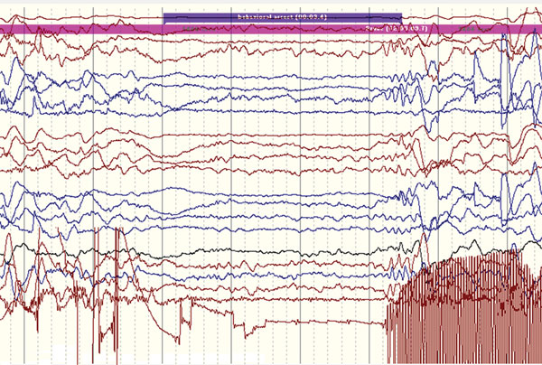 Ictal electroencephalographic recording of a 12-year-old boy in Uganda with nodding syndrome obtained during a typical nodding episode. Shown is a sudden electrodecremental episode with concomitant electromyographic decrease in neck muscles, followed by sharply contoured theta activity. 