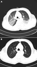 Thumbnail of Chest computed tomography scan images of patient (case-patient 2) in a study of 4 persons with early cases of influenza A(H7N9) virus infection, Shanghai, China. A) Image taken 6 days after illness onset shows ground-glass opacity in the left lower and right upper lobes. B) Image taken 16 days after illness onset shows absorption of ground-glass opacity.