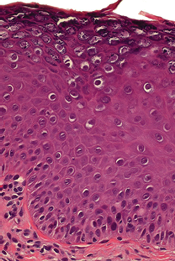 Histopathologic findings for a representative biopsy of skin lesions (erythematous warts) from a female patient before she was administered human papillomavirus vaccine. Analysis revealed features typical of benign cutaneous warts, including acanthosis, parakeratosis, and numerous koilocytes. Vacuolated granular cells show prominent keratohyalin granules, characteristic of human papillomavirus infection (hematoxylin-eosin staining; original magnification ×200).