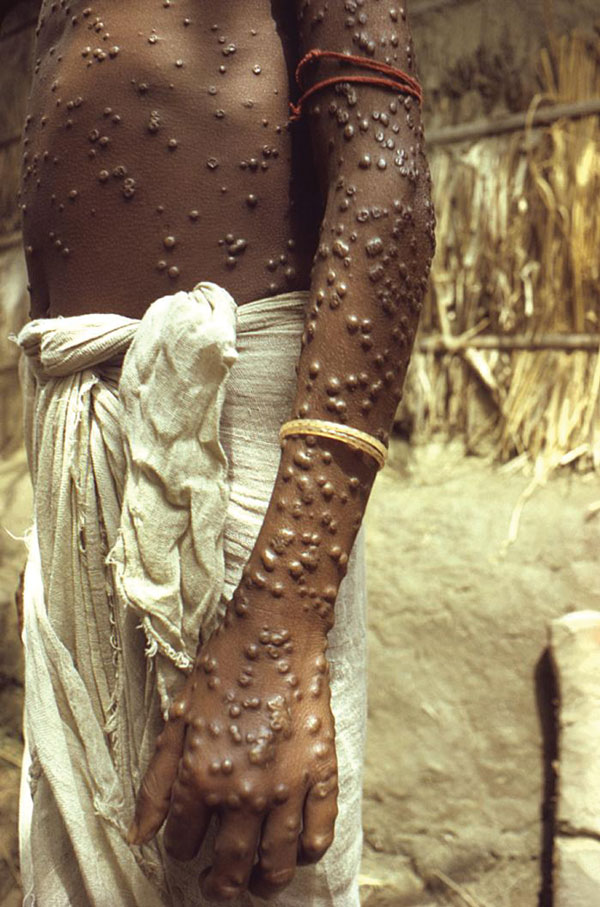 Patient with smallpox. Photograph by Jean Roy, provided by the Public Health Image Library, Centers for Disease Control and Prevention, Atlanta, GA, USA. 