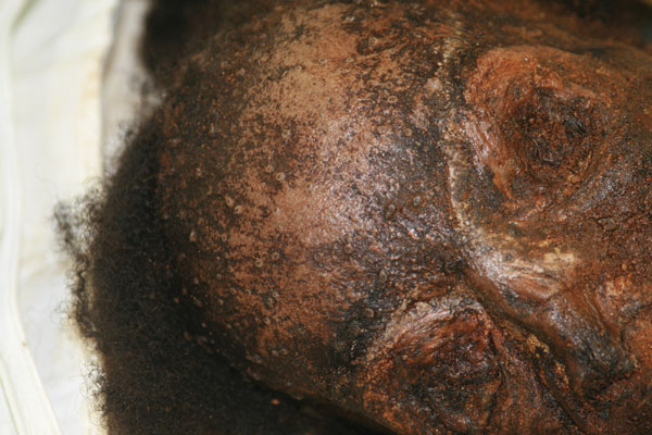 Mummified remains of a woman buried in an iron coffin, New York, New York, USA, mid-1800s. Photograph provided by Don Weiss.