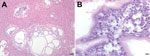 Thumbnail of Microscopic images of liver sections from a Bornean orangutan fatally infected with Versteria metacestodes. Images of liver sections stained with hematoxylin and eosin (H&amp;E) stain were captured at 10× magnification (A; scale bar = 30 μm) and 100× magnification; B; scale bar = 5 μm). Large numbers of parasite cells can be seen within well-defined cystic structures separated from the surrounding host tissue by clearly visible membranes.