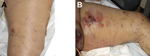 Thumbnail of Manifestation of heroin-associated anthrax in patient 1, who injected heroin under the skin of her left thigh. Panel A demonstrates substantial edema and blistering of skin. Manifestation is more pronounced in Panel B, which demonstrates more blistering and bruising.