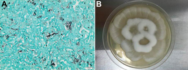 Histopathologic findings from a 34-year-old man with X-linked gp91phox gene mutation chronic granulomatous disease. A) Liver biopsy results showing numerous irregular and nonseptate hyphae with bulbous dilations. Gomori methenamine silver stain. Original magnification ×400. B) Culture of Mortierella wolfii, after 3-days of incubation at 30°C on Sabouraud agar medium.