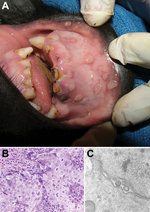 Thumbnail of Vesicular stomatitis in a wild-caught juvenile Grauer’s gorilla (Gorilla beringei graueri). Gross lesions, histopathologic examination, transmission electron microscopy, and molecular screening confirmed human herpesvirus type 1 (HSV-1) as the etiologic agent. A) Human HSV-1 lip lesions in a wild-caught juvenile Grauer’s gorilla. B) Section of oral mucosa adjacent to a vesiculo-ulcerative lesion exhibits epithelial cell necrosis, cytoplasmic swelling, nuclear chromatin margination (