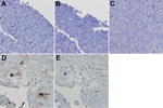 Thumbnail of WU polyomavirus antigen in bronchoalveolar lavage specimens from lungs transplanted into a recipient (28-year-old woman) with Job syndrome. Immunohistochemical analysis of 293T cells transfected with pDEST26-WU–virus protein 1 and stained as follows. A) WU virus protein 1 monoclonal antibody (NN-Ab06). B) Isotype control. C) Mock transfected 293T cells stained with NN-Ab06. D) Bronchoalveolar lavage specimen stained with NN-Ab06 showing prominent dark staining of cells with enlarged