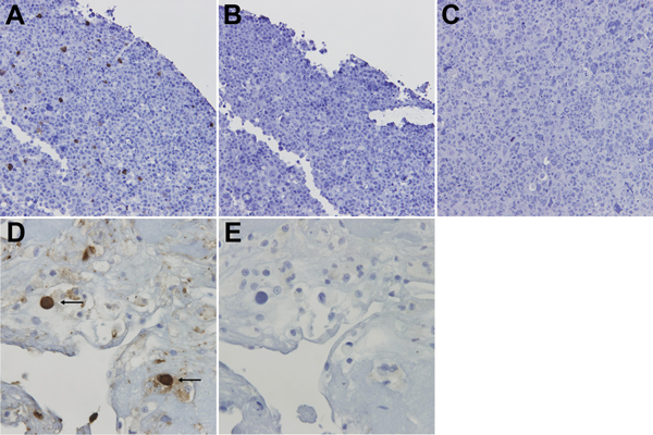 WU polyomavirus antigen in bronchoalveolar lavage specimens from lungs transplanted into a recipient (28-year-old woman) with Job syndrome. Immunohistochemical analysis of 293T cells transfected with pDEST26-WU–virus protein 1 and stained as follows. A) WU virus protein 1 monoclonal antibody (NN-Ab06). B) Isotype control. C) Mock transfected 293T cells stained with NN-Ab06. D) Bronchoalveolar lavage specimen stained with NN-Ab06 showing prominent dark staining of cells with enlarged nuclei and a