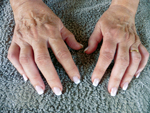 Thumbnail of Swollen and stiff hands of a 70-year-old woman with post-chikungunya rheumatoid arthritis 10 months after acute infection with chikungunya virus, Saint Martin.