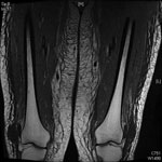 Thumbnail of Magnetic resonance image of 63-year-old woman in Australia with disseminated enteroviral infection that manifested after she received obinutuzumab for lymphoma. Image shows patient’s thighs and diffuse inflammatory changes involving subcutaneous tissues, fascia, and musculature.