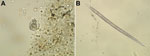 Thumbnail of Ancylostoma ceylanicum hookworm isolated from a French tourist returning from Myanmar. A) Ova and blood cells in fecal specimen. B) Filariform larvae after stool culture. Original magnifications ×40.