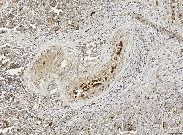 Spleen of the youngest female sperm whale (SW3) in study of 7 sperm whales stranded along Italy’s Adriatic coastline in September 2014. Positive immunostaining (Mayer’s hematoxylin counterstain) for morbilliviral antigen is shown in monocytes within vascular lumina and in follicular dendritic-like cells in the splenic white pulp. Morbillivirus immunohistochemistry was conducted with a murine monoclonal antibody against canine distemper virus nucleoprotein (VMRD Inc., Pullman, WA, USA). Original 