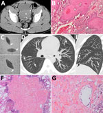 Thumbnail of Schistosomiasis-induced squamous cell carcinoma of the bladder with pseudometastatic pulmonary nodules in a 30-year-old man from Mali. A) An unenhanced computed tomography axial image shows diffuse calcification of the wall bladder (arrow). A soft-tissue mass arises from the left posterolateral wall, breaching the calcifications and reaching the perivesical fat (asterisk). B) Anatomopathology slide stained with hematoxylin and eosin (original magnification ×10) of the bladder wall s