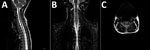 Thumbnail of Magnetic resonance images of brain of a 3-year-old girl with enterovirus encephalomyelitis (paresis of the right upper limb). A) Image of the cervical spine: sagittal T2 sequence; B) short tau inversion recovery (STIR) coronal sequence; C) T2 axial sequence. Hyperintense filiform lesions in the anterolateral regions of the spinal cord (C3–C5), predominantly right, are suggestive of myelitis.