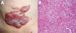 Thumbnail of Lobomycosis in a 41-year-old soldier (case-patient 2), Colombia. A) Erythematous, lobulated plaque (4 cm × 2.5 cm) on the sternal notch with hematic crust and black areas on the surface. B) Periodic acid–Schiff staining of a biopsy specimen from the lesion shows the dermis occupied by diffuse, inflammatory granulomata with chains of yeasts (original magnification ×10).