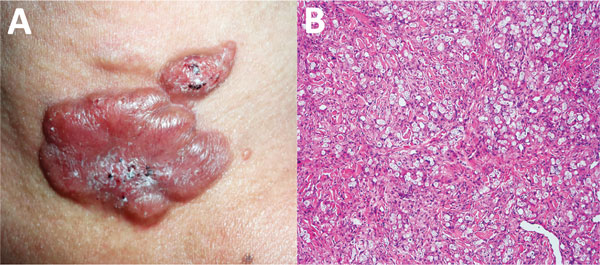 Lobomycosis in a 41-year-old soldier (case-patient 2), Colombia. A) Erythematous, lobulated plaque (4 cm × 2.5 cm) on the sternal notch with hematic crust and black areas on the surface. B) Periodic acid–Schiff staining of a biopsy specimen from the lesion shows the dermis occupied by diffuse, inflammatory granulomata with chains of yeasts (original magnification ×10).