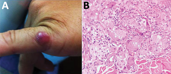 Lobomycosis in a 36-year-old soldier (case-patient 3), Colombia. A) Solitary erythematous-violaceous nodule with a shiny surface and firm consistency (diameter 1 cm) located on the fifth finger of the left hand. B) Hematoxylin and eosin staining of a biopsy specimen from the lesion shows giant cells and numerous yeast structures (original magnification ×20).