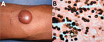 Thumbnail of Lobomycosis in a 32-year-old soldier (case-patient 5), Colombia. A) Solitary yeast erythematous nodule (4 cm × 3.5 cm) resembling a keloid scar with a smooth and shiny surface on the right arm. B) Grocott staining of a biopsy specimen from the lesion shows typical chains (original magnification ×40).