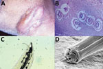 Thumbnail of Lagochilascariasis in a 54-year-old male hunter in Brazil. A) Nodular tumorous lesion on cervical region caused by L. minor infection. B) Biopsy of nodular lesion showing granuloma and larvae of L. minor nematode. Hematoxylin and eosin staining. Original magnification ×50. C) Optic microscopy shows the ejaculatory duct with spicule and lateral alae of L. minor. The ratio of ejaculatory duct length to spicule length of the worms is ≈2. Original magnification ×50. D) Scanning electron