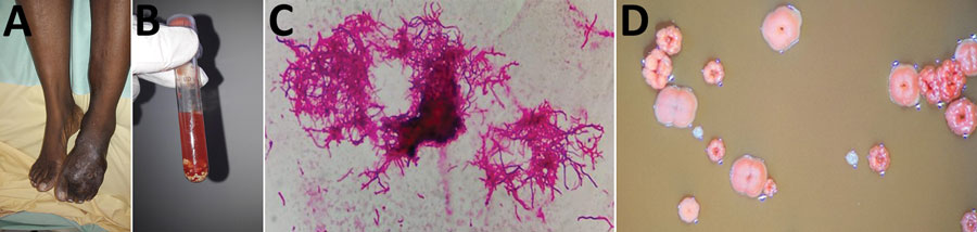 Actinomycetoma caused by Actinomadura mexicana infection in a 38-year-old woman from Haiti, France. A) Multinodular lesions on the dorsal surface of the left foot. B) Liquid from puncture of the nodules, showing white-yellow grains. C) Gram-positive bacilli branching out, characteristic of actinomycetal bacteria (original magnification ×1000). D) Colonies after an 8-day incubation, showing warty ornamentation, pink to pallid red, convex, with a wrinkled morphology (observed through binocular mag