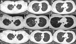 Chest computed tomography scan 1 month after antituberculosis treatment initiation (A–C), at the time of Mycolicibacter kumamotonensis identification (D–F), and 1 year after treatment initiation for M. kumamotonensis (G–I). Resolution of cavities and scar formation (A to D to G), resolution of pulmonary infiltrations (B to E to H), and hardening of the nodular appearances (C to F to I) are shown.