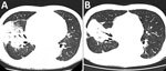 Computed tomographic scan of the chest of a patient hospitalized with Legionella longbeachae. A) On day 14 of the patient’s hospital stay, extensive consolidation was present in the right upper and middle lobe. B) On day 25 of the patient’s hospital stay, the consolidation was smaller than before.