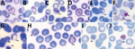 Thumbnail of Plasmodium cynomolgi and P. knowlesi parasites in patient K07, admitted to Kapit Hospital with malaria during June 24, 2013–December 31, 2017, Malaysian Borneo. A–G) Early trophozoites of P. cynomolgi in enlarged and, at times, distorted erythrocytes, with Schüffner’s stippling and either single, double, or triple chromatin dots. E–H) P. knowlesi and P. cynomolgi early trophozoites. I) Band form trophozoite of P. knowlesi. J) Schizont of P. knowlesi. Pcy, P. cynomolgi; Pk, P. knowle