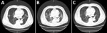 Chest computed tomography (CT) scan of a patient on hemodialysis diagnosed with positive reverse transcription PCR for severe acute respiratory syndrome coronavirus 2 in hemodialysis effluent, Japan. A) Chest CT at day 1 of hospitalization showing bilateral patchy ground glass opacities (GGO). B) Chest CT from day 5 of hospitalization showing worsening coronavirus disease 2019 (COVID-19) pneumonia with GGO expansion. C) Chest CT on hospitalization day 16 showing improvement of COVID-19 pneumonia; the patient was discharged on this day. A, anterior; P, posterior.