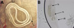 Identification of Breinlia sp. nematodes from a patient with ocular filariasis, Brisbane, Queensland, Australia, 2019. A) Photograph (in situ) of male B. (Johnstonema) annulipapillata nematode from the subconjunctiva, illustrating thick heavily sclerotized spicules (s). B) Right lateral view of male tail of B. (J.) annulipapillata nematode, illustrating left (ls) and right (rs) spicules; right spicules showed a bifurcated distal extremity (dt), a diagnostic character of the species.