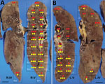 Molecular detection of SARS-CoV-2 and Streptococcus pneumoniae in the lungs of a patient in Japan co-infected with both pathogens. The 42 lung sections were analyzed and the amount of SARS-CoV-2 RNA and S. pneumoniae DNA in each section was evaluated. A) The right lung was cut into 6 (R–I to R–VI); B) the left lung was cut into 7 (L–I to L–VII) coronal slices, from ventral to dorsal. Twenty-two right sections (R1–R22) in R–IV and R–V and 20 left sections (L1–L20) in L–V and L–IV are shown in black boxes. The dotted white line is the boundary between the upper and lower lobes. The SARS-CoV-2 RNA score is indicated by the number of red circles and the S. pneumoniae DNA score is indicated by the number of yellow circles. (-) indicates results under the detection limit. Scale bars indicate 2 cm. SARS-CoV-2, severe acute respiratory syndrome coronavirus 2.