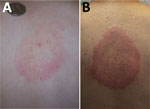 Southern tick-associated rash illness skin lesions. Adapted from Centers for Disease Control and Prevention, National Center for Emerging and Zoonotic Infectious Diseases, Division of Vector-Borne Diseases.