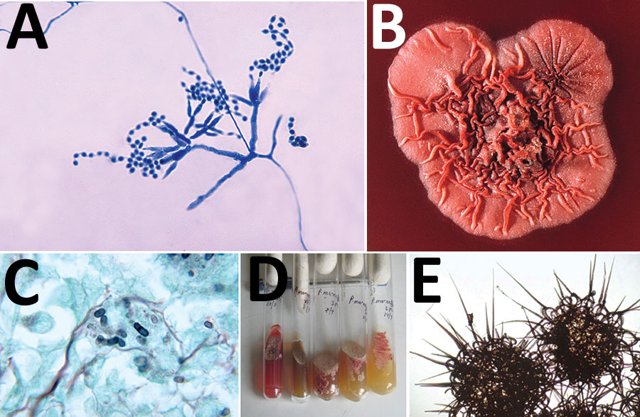 A) Ultrastructural morphology of Talaromyces marneffei, including chains of single-celled, teardrop-shaped conidia, each originating from its respective, flask-shaped phialide. Source: Libero Ajello, Centers for Disease Control and Prevention (https://phil.cdc.gov/Details.aspx?pid = 4240). B) Superior (front) view of a petri dish culture plate on which a wrinkled colony of Penicillium marneffei has been cultivated. Source: James Gathany, Centers for Disease Control and Prevention (https://phil.cdc.gov/Details.aspx?pid = 1879). C) Mouse testicle tissue specimen showing globe-shaped yeast cells of T. marneffei undergoing multiplication by binary fission not by mitosis (methenamine silver stain). Source: Libero Ajello, Centers for Disease Control and Prevention (https://phil.cdc.gov/Details.aspx?pid = 4235); D) Gradual conversion of mycelial phase of T. marneffei (growth at 25°C) to yeast phase on brain heart infusion agar after incubation at 37°C. Mycelial phase (first tube marked 25°C) shows diffusible red pigment. Source: Monika Mahajan, Postgraduate Institute of Medical Education and Research, Chandigarh, India; E) Loose network of hyphae of T. marneffei forming gymnothecium that contains asci. Source: https://istudy.pk/ascomycota-fruit-bodies/.