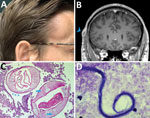 Dirofilaria repens infection in man in Germany after travel to India. A) Painless temporal subcutaneous swelling (image taken by the patient at the time of maximal protrusion). B) Contrast-enhanced magnetic resonance image (fat-saturated T1-weighted sequences) demonstrating a subcutaneous 10-mm lesion with central hypointensity and contrast uptake of the surrounding capsule (arrowhead). C) Cross-section through adult D. repens worm in subcutaneous tissue, demonstrating the cuticle with external ridges (arrow heads) and internal structures such as smooth muscle fibers (arrows) and gravid uteri (stars). Original magnification ×100; periodic acid-Schiff stain. D) D. repens microfilaria of the Asian genotype. Typical features include lack of a sheath, 2–3 separate nuclei in the head space, and absence of nuclei in the tip of the tail. Original magnification ×1,000 with oil; Giemsa stain.