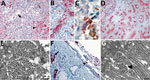 Pulmonary histopathologic, immunohistochemical (IHC), in situ hybridization, and ultrastructural findings in tissues from a neonate in the United States with severe acute respiratory syndrome coronavirus 2 (SARS-CoV-2). A) Lower magnification of the lung showing diffuse alveolar damage, characterized by type II pneumocyte hyperplasia (arrowhead), hyaline membrane (arrow), and interstitial mononuclear infiltrate. Original magnification ×20. B) Extensive intra-alveolar immunostaining by spike protein SARS-CoV-2 IHC assay. Original magnification ×40. C) Double-stain IHC assay showing rare macrophages with SARS-CoV-2/CD-163–positive immunostaining. Red, SARS-CoV-2; brown, CD-163 antibody (arrow). Original magnification ×63. D) Extensive staining of SARS-CoV-2 genomic RNA in pneumocytes by nucleocapsid gene in situ hybridization assay. Original magnification ×10. E) Electron microscopy (EM) image of a pneumocyte containing accumulations of intracellular viral particles. Scale bar indicates 200 nm; viral particles were on average 65 nm in diameter, smaller than commonly observed because of shrinkage during processing. F) Immunostaining of tracheal epithelial cells (arrowhead) and submucosal glands (arrow) by SARS-CoV-2 nucleocapsid IHC assay. Original magnification ×20. G) EM image of a ciliated epithelial cell with extracellular viral particles (arrow) associated with the cilia. Scale bar indicates 200 nm. EM images were collected from 4-μm sections of formalin-fixed, paraffin-embedded tissues affixed to glass slides that were embedded for EM.