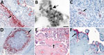 In situ hybridization (ISH) slides demonstrating localization of severe acute respiratory syndrome coronavirus 2 (SARS-CoV-2) genomic RNA in heart, liver, and lymph node tissues and electron microscopic evidence of viral particles in heart tissue from neonate in the United States that died with SARS-CoV-2 infection and placental histopathology and angiotensin-converting enzyme-2 immunohistochemical stain slides. A) SARS-CoV-2 RNA staining by nucleocapsid gene ISH assay in the endothelial cells in myocardium vessel walls (arrow). Original magnification ×20. B) Extracellular virus particles in the connective tissue of the heart (arrow). Scale bar indicates 100 nm. C) Intravascular staining by nucleocapsid gene ISH assay in the liver parenchyma (arrow). Original magnification ×20. D) Extensive nucleocapsid gene ISH staining within macrophages of subcapsular sinus of lymphoid follicle in the submucosa of upper airway (arrow). Original magnification ×10. E) Second trimester placenta with fibrinoid necrosis (arrow). Original magnification ×20. F) Angiotensin-converting enzyme 2 immunostaining in the membrane polarized on the maternal lake side in the syncytiotrophoblast (arrow). Original magnification ×63.