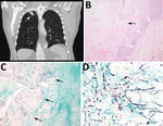 Radiologic and pathologic findings in a 61-year-old immunocompromised man with a history of lung adenocarcinoma and a new 2.4 cm right upper lobe mass determined to be a pulmonary fungus ball caused by Rigidoporus corticola (Oxyporus corticola) infection, United States. A) Chest computed tomography scan. Arrow indicates a 2.4 × 2.2 cm ovoid pulmonary mass in the right upper lobe. B) Hematoxylin and eosin–stained histologic sections of the resected mass. Black arrow indicates a cavitary lesion with a necrotic center. White arrows indicate peripheral fibrous capsule. Original magnification ×100. C, D) Gomori methenamine silver–stained histologic sections. C) Arrows indicate numerous hyphae within the cavity, but no evident invasion into blood vessels or surrounding tissue. Original magnification ×40. D) Arrow indicates septate thin hyphae evident in the center of the cavity. Original magnification ×600.