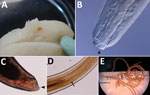 A) A coiled Pseudoterranova sp. L3 larva in a fillet of cod. B) View of the anterior (head) end of an aniskaid larvae, possibly Pseudoterranova sp., showing lips and an indistinct boring tooth (arrowhead) viewed by differential interference contrast microscopy. C) posterior with mucron (arrow). D) Center (cleared with lactophenol) demonstrating the ventriculus and anteriorly directed intestinal cecum (arrowhead). E) gross morphology of adult Pseudoterranova sp. L3 larvae. Original magnifications ×100 in panels B, C, and D; ×10 in panel E. Blaine Mathison, Henry Bishop, Division of Parasitic Diseases, Centers for Disease Control and Prevention.