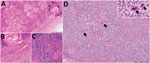 Histologic analysis of lungs and spleen of a bottlenose dolphin (Tursiops truncatus) with Photobacterium damselae subspecies damselae pneumonia, eastern Mediterranean Sea. A) Lung tissue showed a nodular structure covered by fibrous capsule (right bottom of figure panel) composed of numerous cholesterol clefts and areas of reactive fibrosis. Hyaline cartilage was observed, interpreted as bronchi and bronchioles. Inset, higher magnification showing an aggregate of cholesterol clefts and hyaline cartilage (arrow). B) Abundant fibrous lung tissue (lower right half) and cellular infiltrates were also observed. C) Different area of the lung parenchyma characterized by increased cellular infiltration. D) Spleen expressed an apparent contraction of the parenchyma showing diffuse cellularity, with only a few defined lymphoid follicles, as well as megakaryocytes (arrows) indicative of extramedullary hematopoiesis. Inset: higher magnification showing 2 adjacent megakaryocytes (arrows). Hematoxylin and eosin stained. Scale bars indicate 500 μm in panel A and 200 μm in panels B–D.