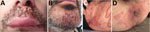 Clinical appearance of Trichohpyton mentagrophytes genotype VII infections in men in France, 2022. A, B) Swollen lesions of the mustache (A) and beard (kerions) (B). C) Papular and nodular inguinal lesions. D) Peri-anal mpox lesions with associated papules and pustules with central umbilication and a large lesion with a central necrotic crust, surrounded by extensive erythemato-squamous circinate lesions caused by TMVII infection.