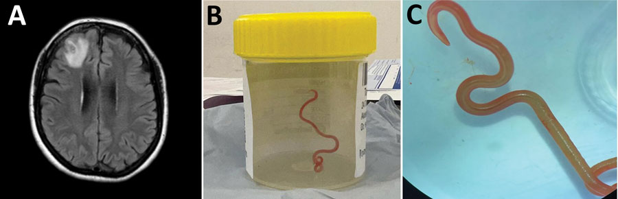 Detection of Ophidascaris robertsi nematode infection in a 64-year-old woman from southeastern New South Wales, Australia. A) Magnetic resonance image of patient’s brain by fluid-attenuated inversion recovery demonstrating an enhancing right frontal lobe lesion, 13 × 10 mm. B) Live third-stage larval form of Ophidascaris robertsi (80 mm long, 1 mm diameter) removed from the patient’s right frontal lobe. C) Live third-stage larval form of O. robertsi (80 mm long, 1 mm diameter) under stereomicroscope (original magnification ×10).